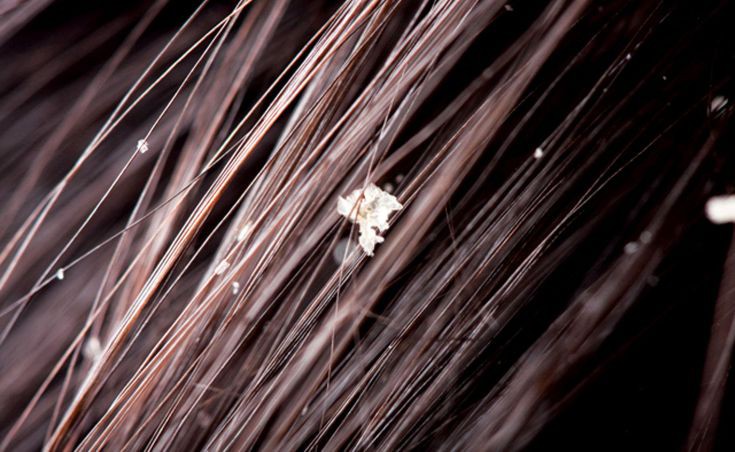 Εξαφανίστε την πιτυρίδα με αλάτι