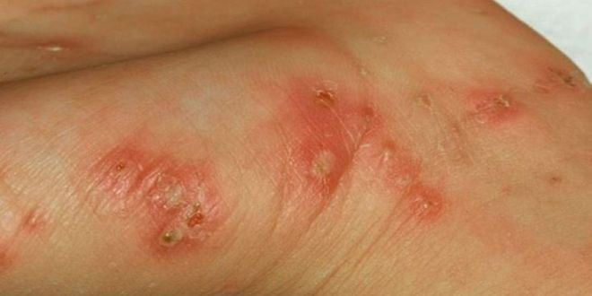 Κρούσματα ψώρας στις φυλακές Μαλανδρίνου της Άμφισσας