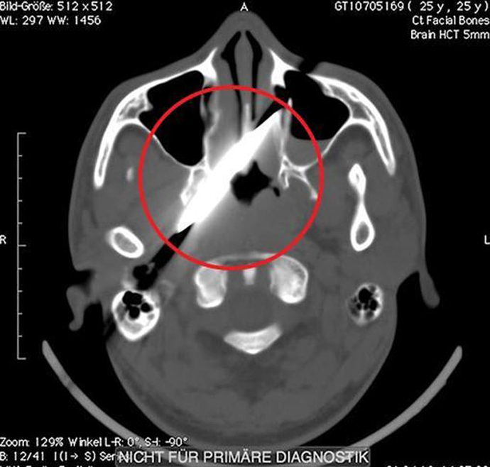 Πήγε στο γιατρό με πονοκέφαλο και ανακάλυψε ότι είχε μαχαίρι στο κεφάλι