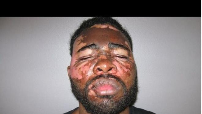 Θαρραλέα γυναίκα πέταξε καυτό λάδι στον διαρρήκτη του σπιτιού της