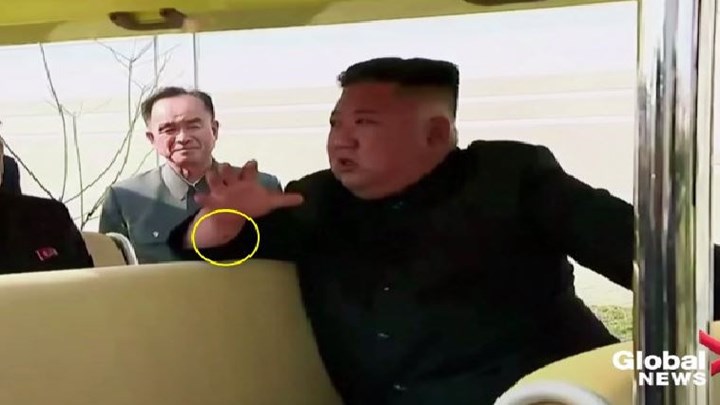 Κιμ Γιονγκ Ουν: Το μυστηριώδες σημάδι στο δεξί του χέρι και τα νέα σενάρια