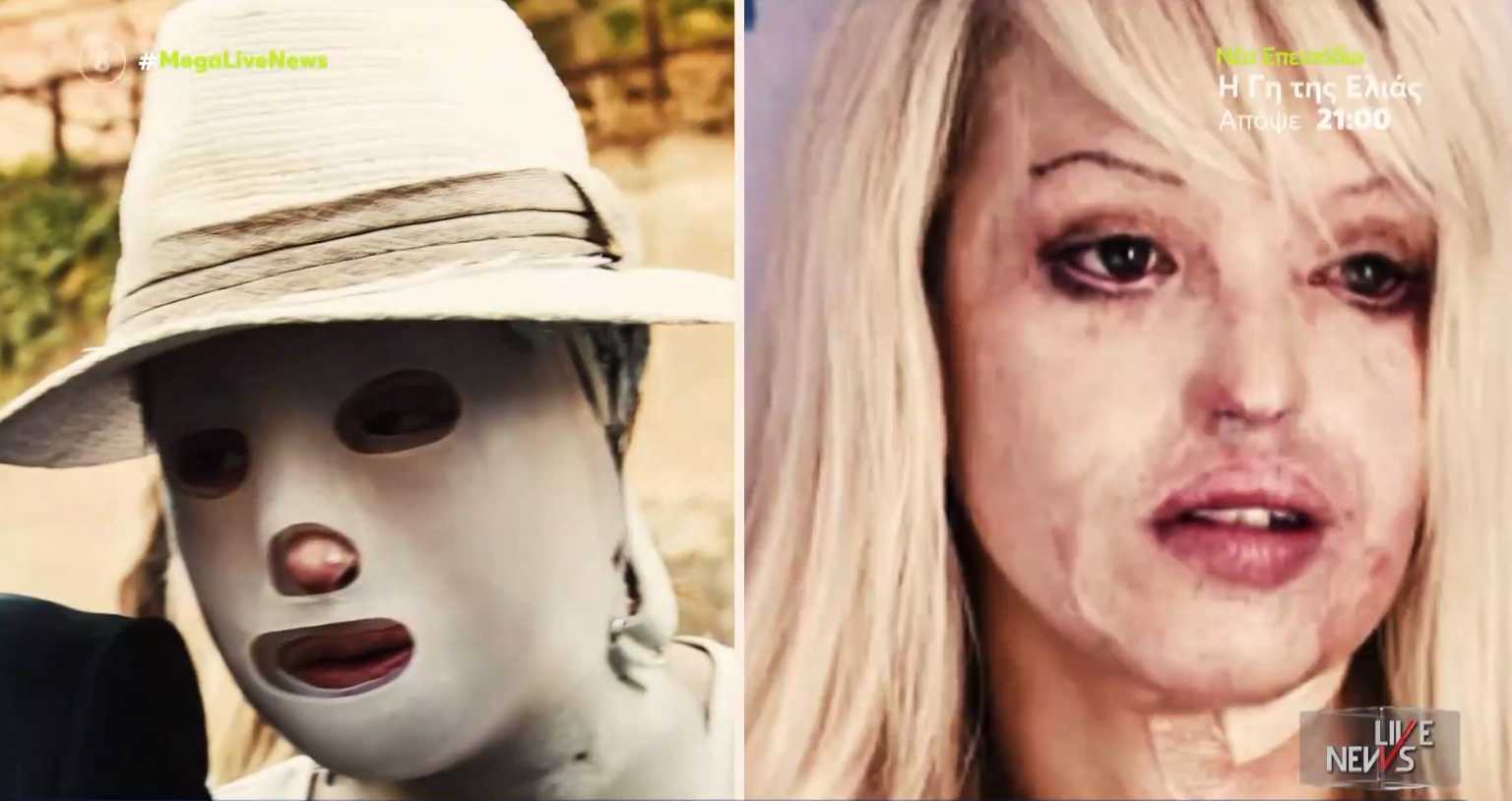 Επίθεση με βιτριόλι: Ιωάννα Παλιοσπύρου – Κέιτι Πάιπερ, δύο ιστορίες με πολλές ομοιότητες