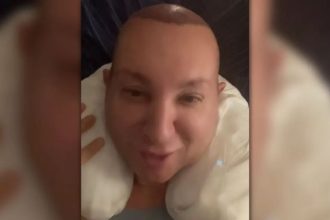 Βασίλειος Κωστέτσος: Το βίντεο μετά την εμφύτευση μαλλιών - «Έχω γίνει φουσκομαγουλίτσα»