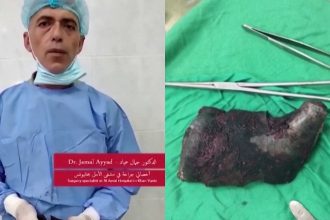 Θραύσμα οβίδας βάρους 1 κιλού αφαιρέθηκε από τραυματία στη Γάζα