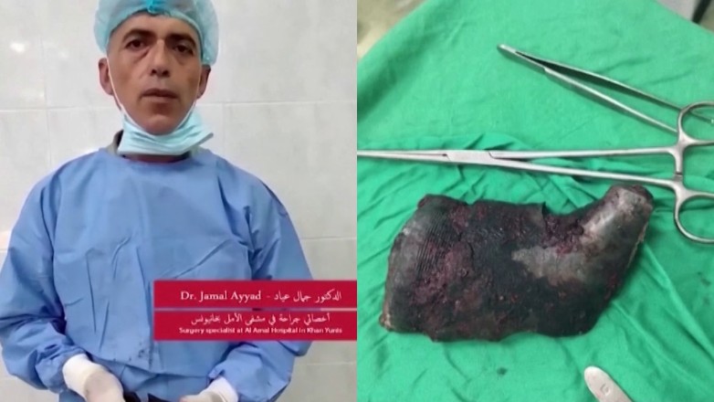 Θραύσμα οβίδας βάρους 1 κιλού αφαιρέθηκε από τραυματία στη Γάζα