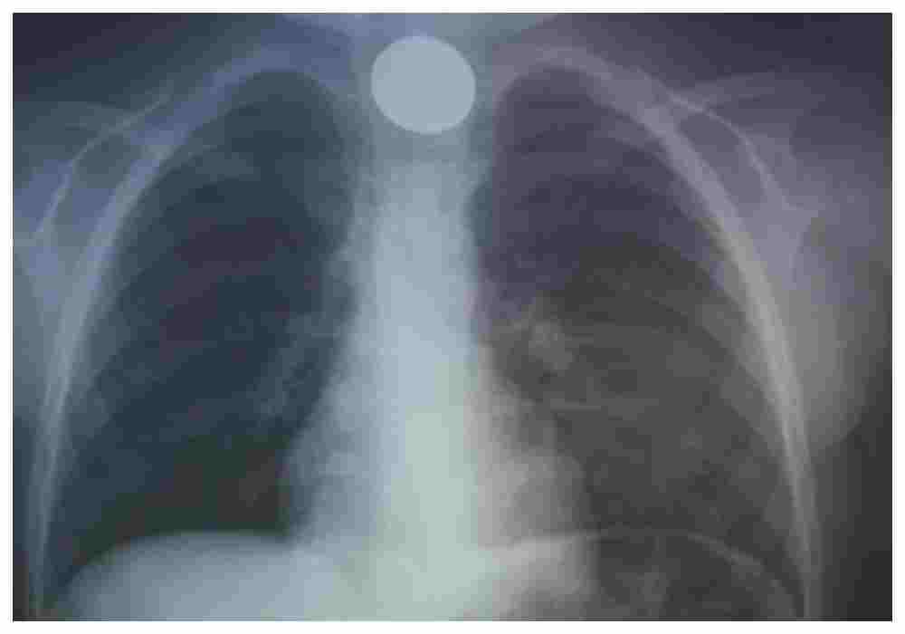 Στο νοσοκομείο 4χρονος που κατάπιε κέρμα