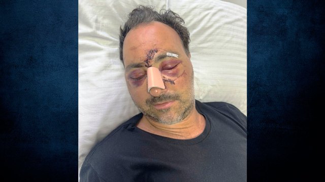 Άγριος ξυλοδαρμός Ελληνοκαναδού χρηματιστή στην Κρήτη για μια παρατήρηση - Του έκαναν 60 ράμματα στο κεφάλι