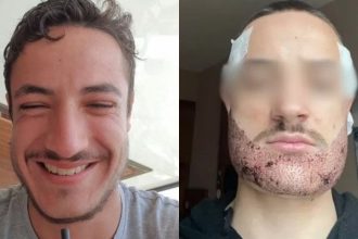 Γαλλία: 24χρονος αυτοκτόνησε μετά από αποτυχημένη επέμβαση για μούσια στην Κωνσταντινούπολη