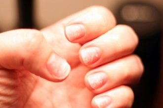 Γιατί σπάνε τα νύχια και τι μπορείτε να κάνετε για να το διορθώσετε στο σπίτι