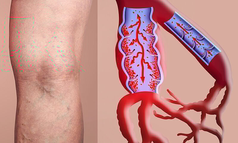 Θρόμβωση: Τα σημάδια-SOS που πρέπει να γνωρίζετε