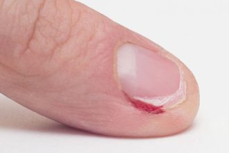 Παρανυχίδες: Τρεις τρόποι για να απαλλαγείτε οριστικά