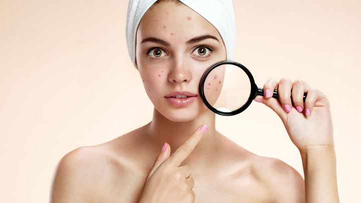 Τι προκαλεί την ακμή και πώς να την καταπολεμήσετε φυσικά