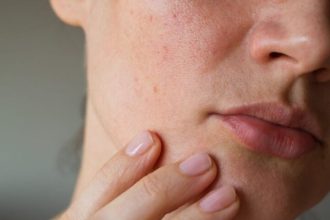 Ξηροδερμία τον χειμώνα: Οι 5 προτάσεις των ειδικών με φυσικά υλικά