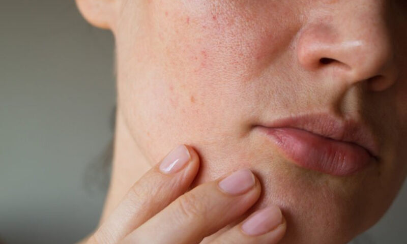 Ξηροδερμία τον χειμώνα: Οι 5 προτάσεις των ειδικών με φυσικά υλικά