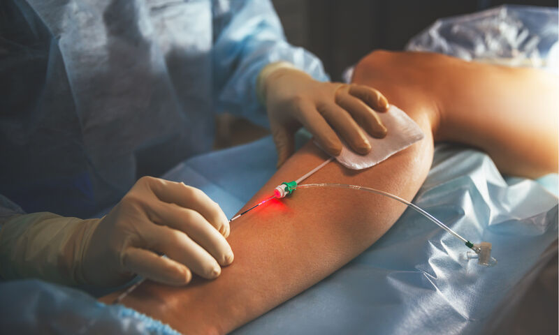 Κιρσοί: Μην βάζετε φρένο στη ζωή σας, θεραπεύστε τους οριστικά