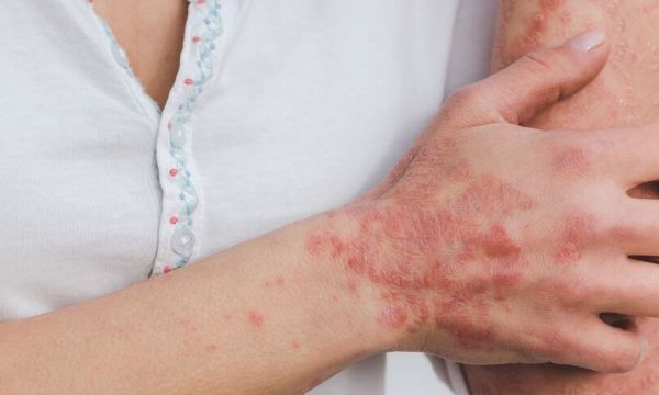 Οι ασθενείς με σοβαρή ψωρίαση διατρέχουν υψηλότερο κίνδυνο για καρδιακές παθήσεις