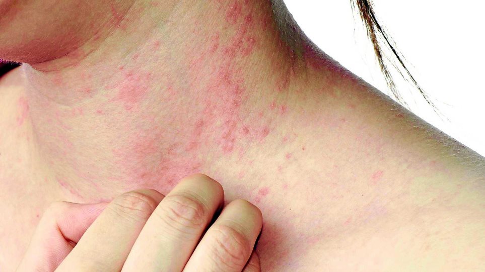 Ψωρίαση: Η νόσος που «ταλαιπωρεί» 200.000 Έλληνες