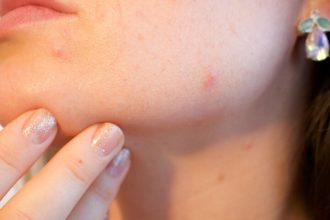 Πώς θα εφαρμόσεις το foundation για να καλύψεις τα σημάδια από ακμή