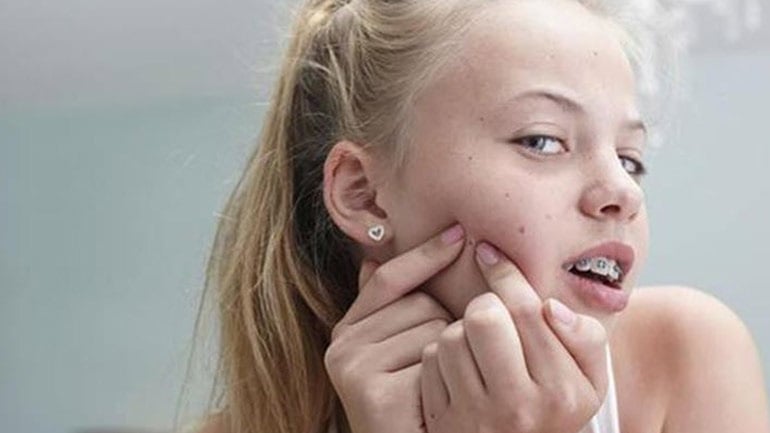 Πώς να βοηθήσετε το παιδί σας να την αντιμετωπίσει την ακμή