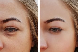 Σακούλες κάτω από τα μάτια: Πώς θα τις εξαφανίσετε