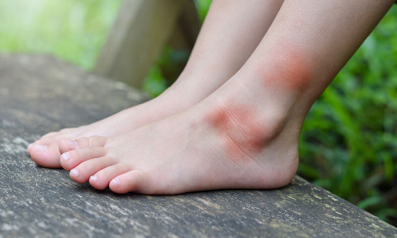 Αλλεργία στο τσίμπημα κουνουπιού: Τα ανησυχητικά συμπτώματα