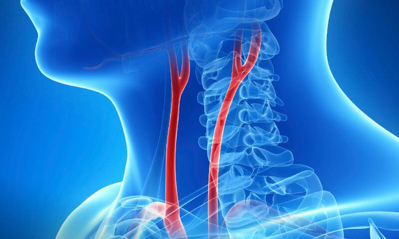 Σκλήρυνση καρωτίδων: Πόσο αυξάνει τον κίνδυνο εγκεφαλικού