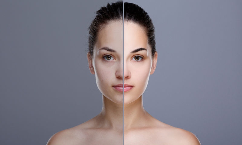 Πανάδες: Γιατί εμφανίζονται και πώς θα τις αντιμετωπίσετε