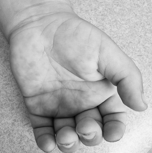 Αμαλιάδα: Ραγίζει καρδιές η ανάρτηση του γιατρού για το 15 μηνών αγγελούδι που δεν μπόρεσε να σώσει