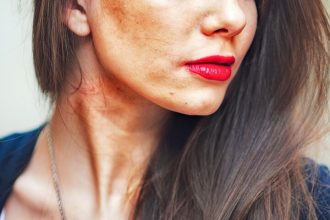 Πανάδες: Συνταγή με τρία υλικά για να τις εξαφανίσετε