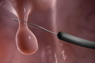 Πολύποδες στη γυναίκα: Πόσο σοβαρό είναι;