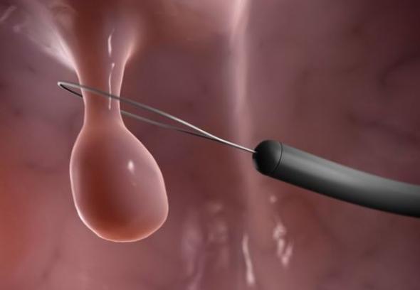 Πολύποδες στη γυναίκα: Πόσο σοβαρό είναι;