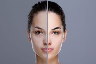 Πανάδες: Γιατί εμφανίζονται και πώς θα τις αντιμετωπίσετε