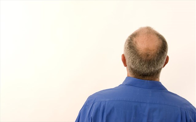 Η εμφάνιση φαλάκρας μπορεί να οφείλεται σε έλλειψη σιδήρου