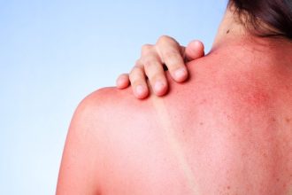 Αντιμετώπισε το κάψιμο από την ήλιο με… φυσικό τρόπο!