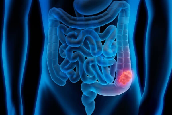 Πώς οι μικροοργανισμοί στο έντερο μπορούν να βοηθήσουν στην αντιμετώπιση του άγχους