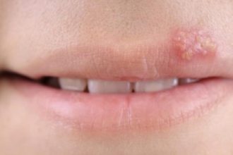 Επιχείλιος έρπης: Γιατί εμφανίσθηκε πάλι;