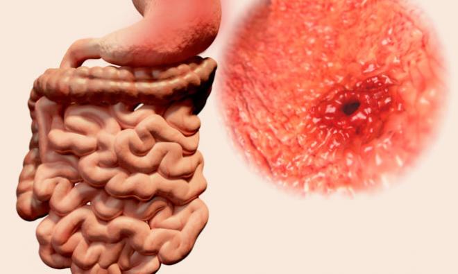 Διάτρηση στομάχου: Συμπτώματα, αίτια, επιπλοκές και θεραπεία