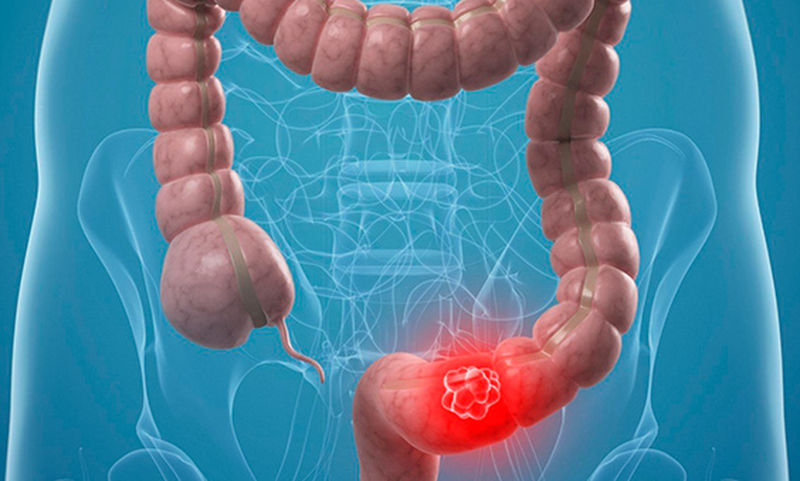 Αυξάνονται τα περιστατικά καρκίνου του εντέρου στους νέους ενήλικες