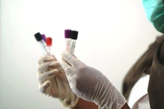 Νέο τεστ αίματος ανιχνεύει με ακρίβεια 90% τον καρκίνο του στομάχου