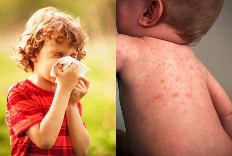 Παιδιά και αλλεργίες - Τα συμπτώματα και τί τις πυροδοτεί