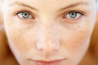 Πώς φεύγουν οι πανάδες προσώπου;