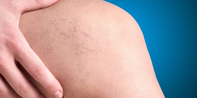 5+1 συχνές ερωτήσεις για τη θεραπεία των κιρσών και των ευρυαγγειών