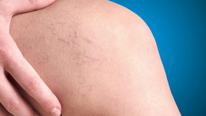 Κιρσοί και ποδήλατο