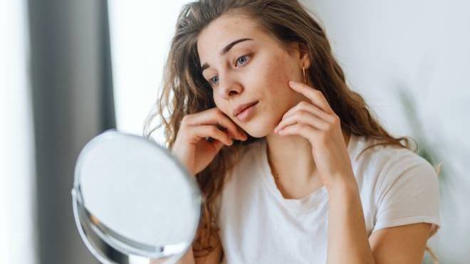 Τα do’s & don’ts για δέρμα με τάση ακμής