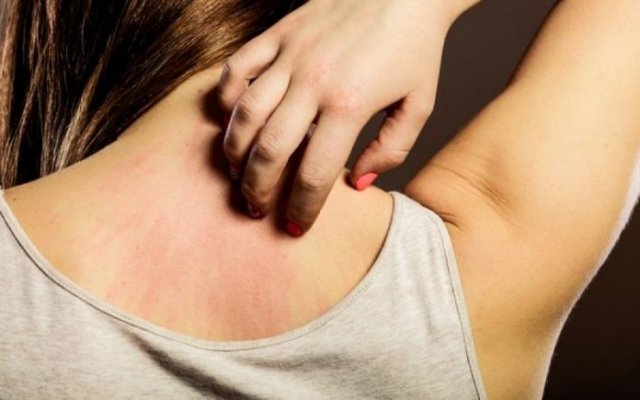 Πώς αντιμετωπίζονται τα εξανθήματα του καλοκαιριού;