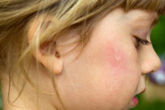 Οι ειδικοί συμβουλεύουν: Tips για να μην τσιμπήσει το παιδί σου κουνούπι