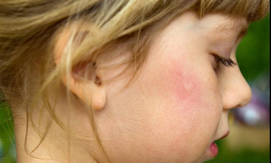 Οι ειδικοί συμβουλεύουν: Tips για να μην τσιμπήσει το παιδί σου κουνούπι