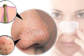 Έχεις μαύρα στίγματα στη μύτη; Έτσι θα εξαφανιστούν