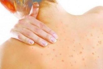 Έχεις σπυράκια στην πλάτη και στο στήθος; Έτσι θα εξαφανιστούν!