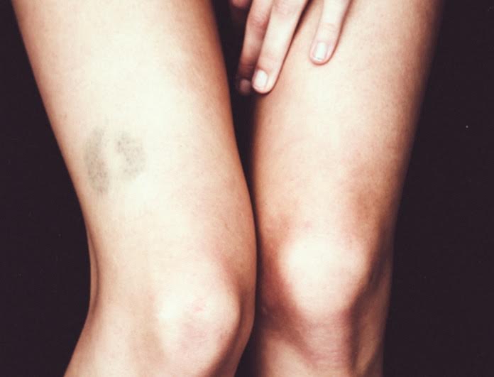 Έχεις μελανιά; Αυτό είναι το μαγικό τρικ για να εξαφανιστεί στο πι και φι!